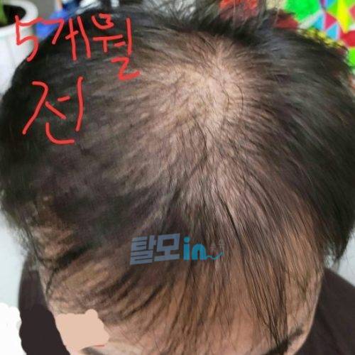 핀페시아 900정 photo review